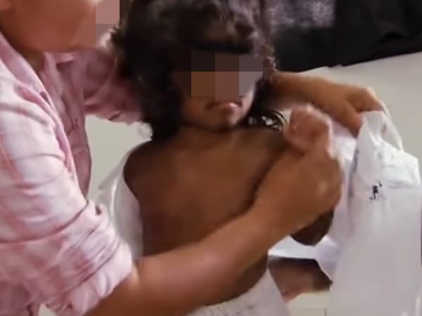 Hipertrikozis, vücutta aşırı kıl büyümesiyle karakterize nadir bir hastalıktır. Doğumda var olan ya da sonradan gelişen iki ana formda görülür. Genellikle "kurt adam sendromu" olarak bilinen bu durum, vücutta her bölgede ya da belirli alanlarda aşırı kıllanma ile kendini gösterir.